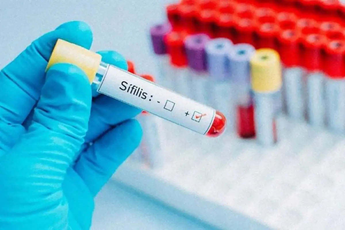 Aumentaron los casos de sífilis en Argentina en 2025