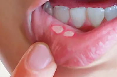 Síntomas y prevención de sífilis: la infección de transmisión sexual en aumento en Tucumán