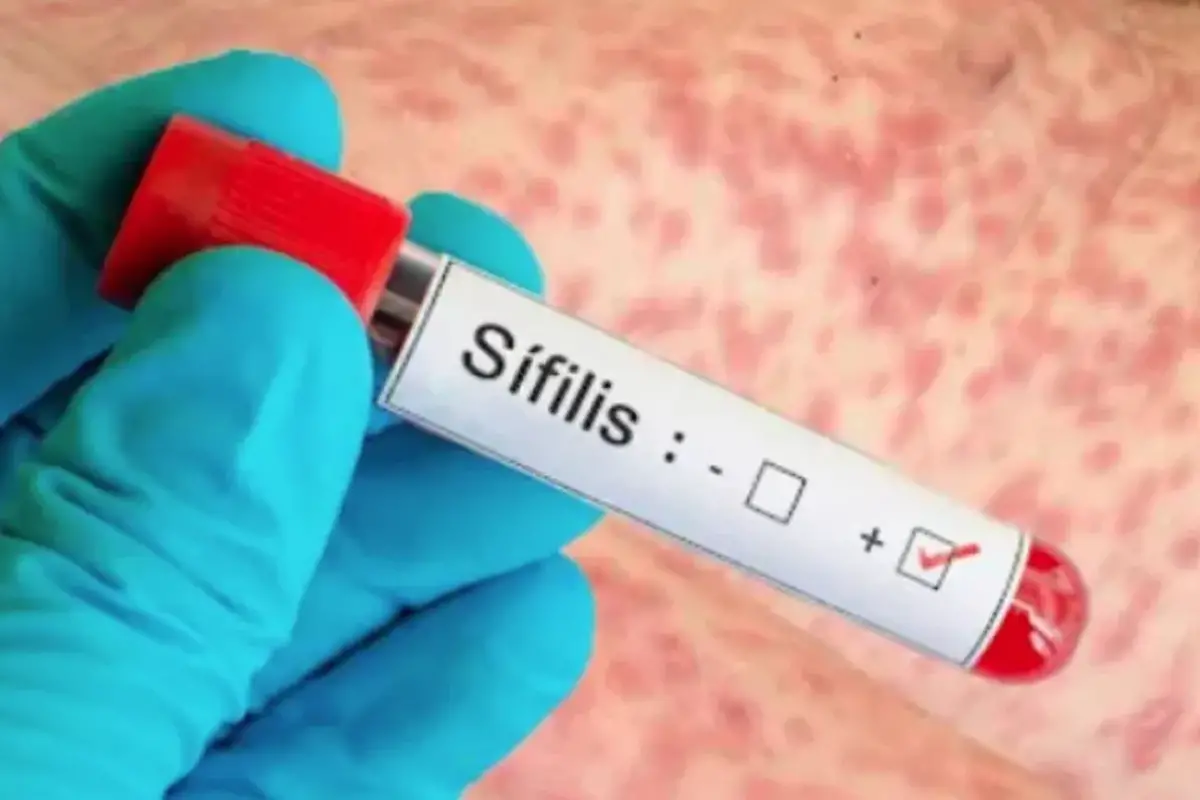 Desde hace años la curva de casos de sífilis va en aumento en el país.