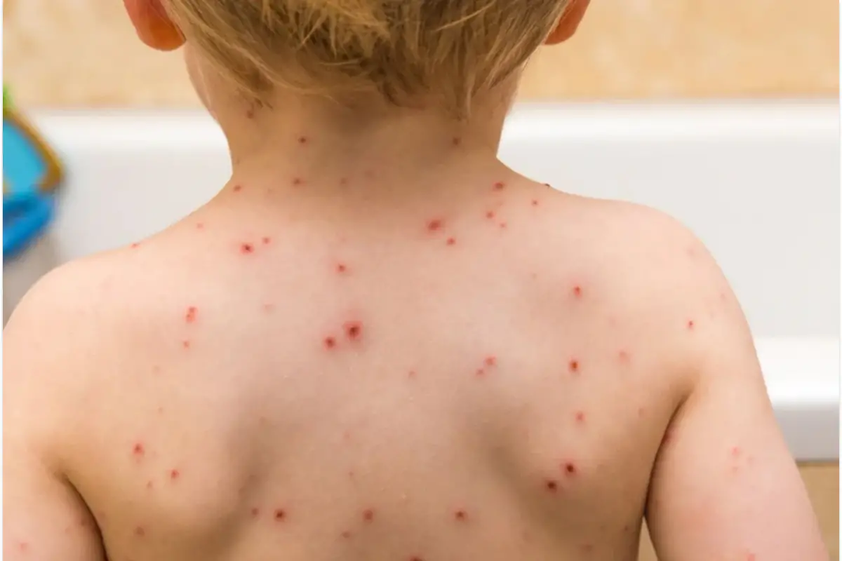 Las complicaciones del sarampión pueden ocasionar desde neumonía hasta ceguera.