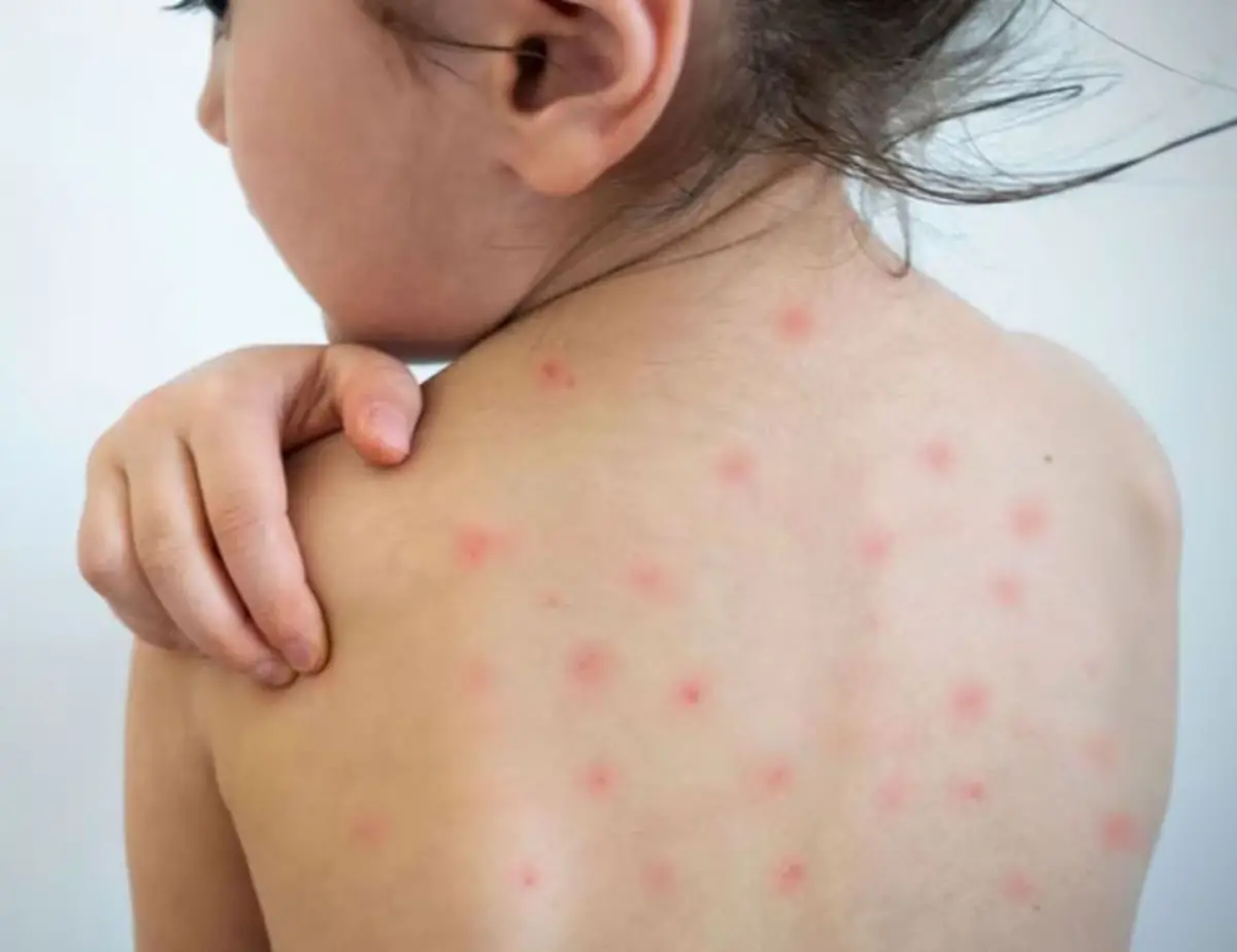 EN ALERTA. La vigilancia epidemiológica se reforzó tras la detección de nuevos casos de sarampión.