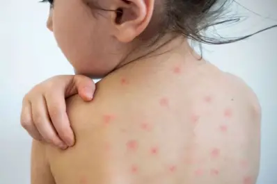 Por qué el sarampión vuelve a ser una amenaza