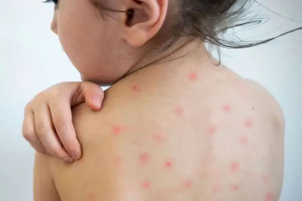 Por qué el sarampión vuelve a ser una amenaza