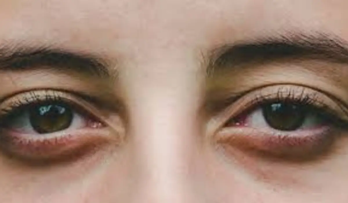 Adiós ojeras: trucos caseros para reducir su impacto en el rosto