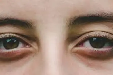 Adiós ojeras: trucos caseros para reducir su impacto en el rosto