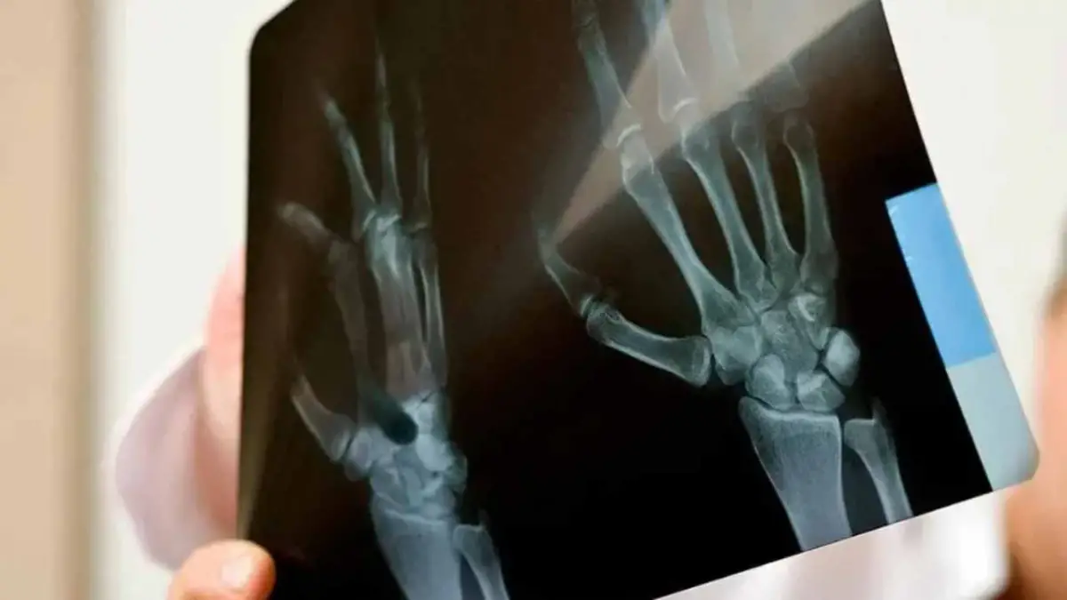 El primer síntoma de cáncer de huesos que una joven detectó a tiempo y le salvó la vida