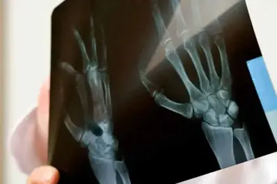 Este síntoma de cáncer de huesos alertó a una joven y le salvó la vida