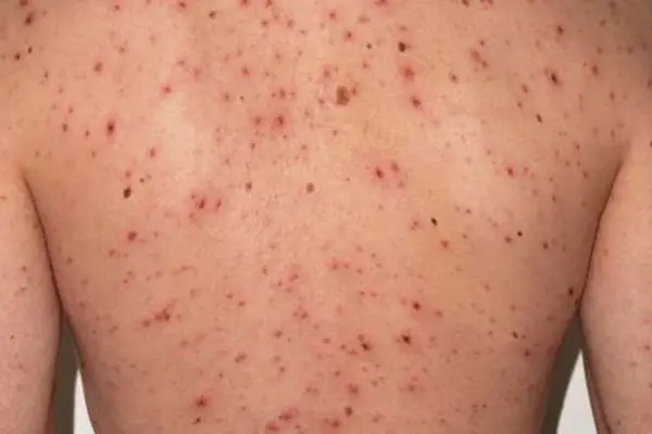 La familia que cruzó el país con sarampión tuvo cerca de 100 contactos estrechos: investigan nuevos casos