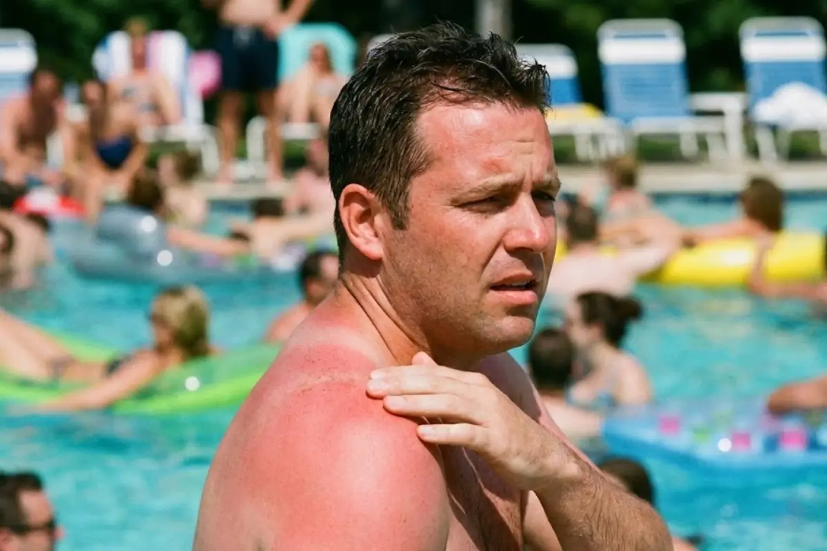 Cuáles son los riesgos de los rayos ultravioletas y su impacto en el cáncer de piel.