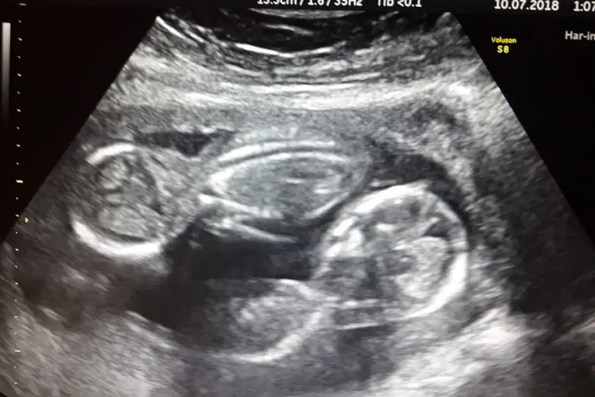 Los embarazos múltiples revisten mayor complejidad para la embarazada.