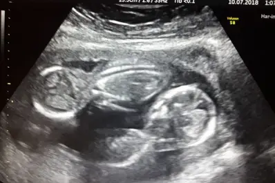 Nacieron trigemelas en Chubut: cuáles son las características de un embarazo múltiple