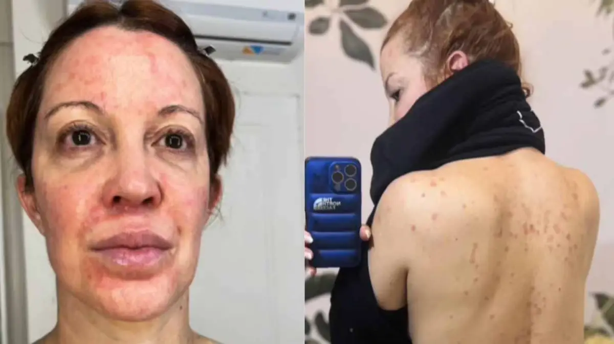 Miriam Lanzoni y su duro relato: la enfermedad que la obligó a dormir envuelta en papel film