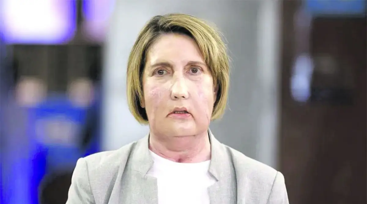 PACIENTE. Carme se sometió al trasplante de cara en Barcelona con resultados satisfactorios. asdf asdf