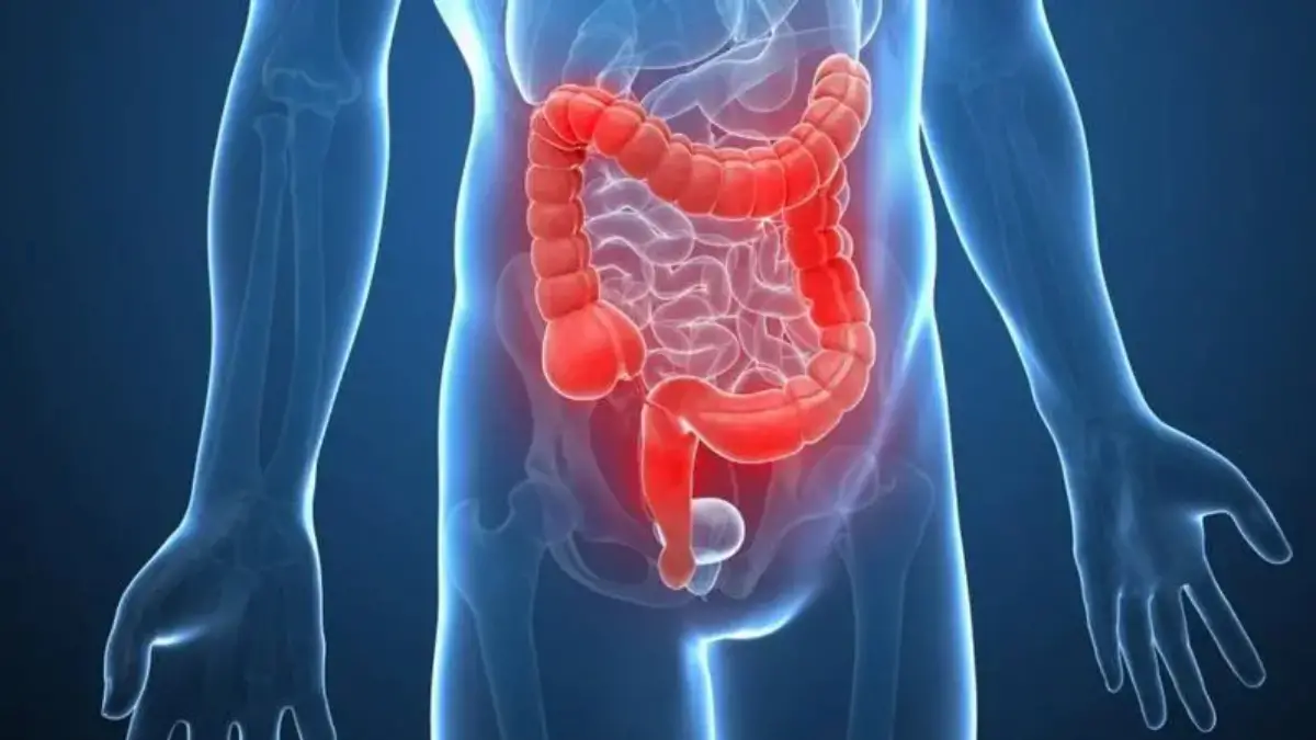 Alerta por cáncer de colon: cuáles son los síntomas tempranos y por qué la detección precoz puede salvar vidas