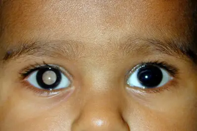 Cuál es el cáncer ocular infantil que puede detectarse de forma temprana