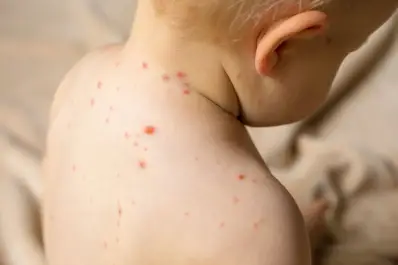 Nuevo caso de sarampión importado en Argentina: ¿cómo evitar el contagio?
