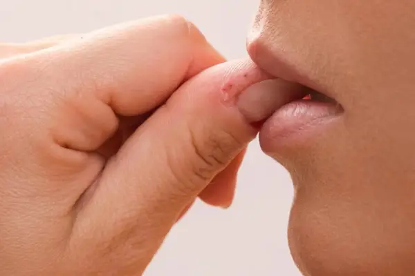 Comerse las uñas: los seis problemas de salud que puede provocar este hábito tan común como nocivo