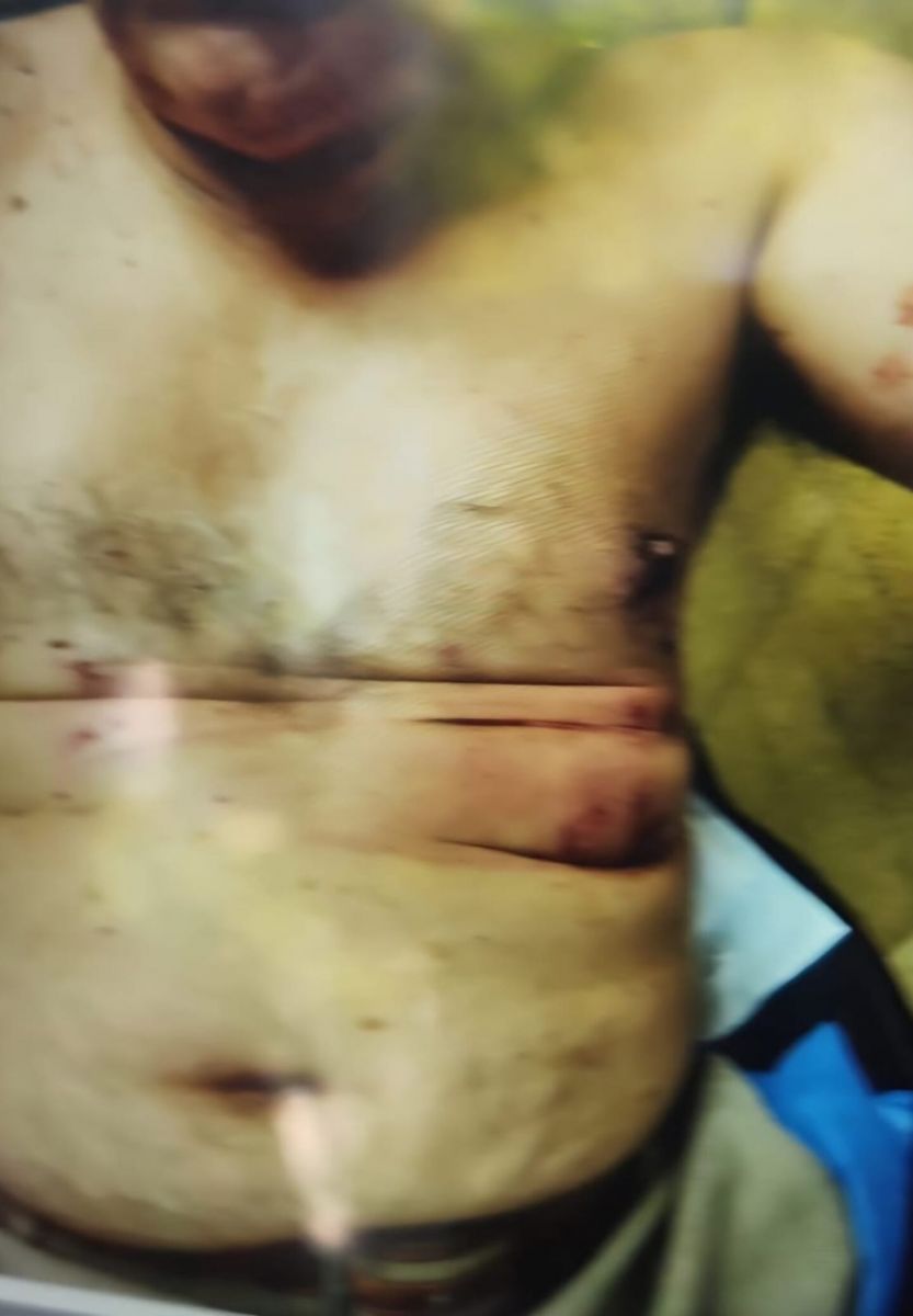 Uno de los heridos sufrió heridas en el torso y el brazo izquierdo. (Foto: TN.)