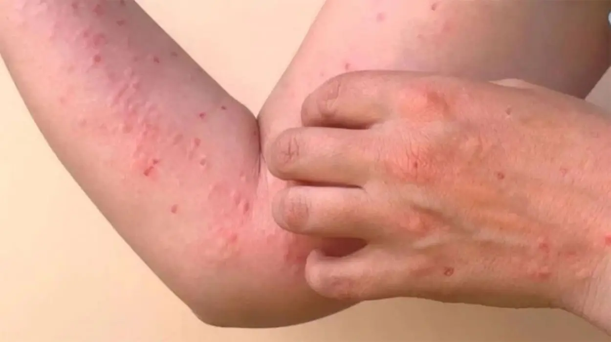 UNO DE LOS SÍNTOMAS. Además del dolor articular intenso, la chikungunya puede provocar erupciones en tronco y extremidades.