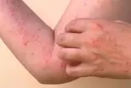 El ministro de Salud confirmó el segundo caso de chikungunya en Tucumán