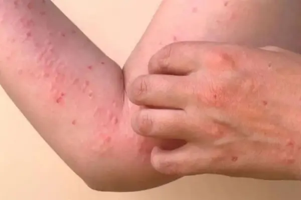 El ministro de Salud confirmó el segundo caso de chikungunya en Tucumán