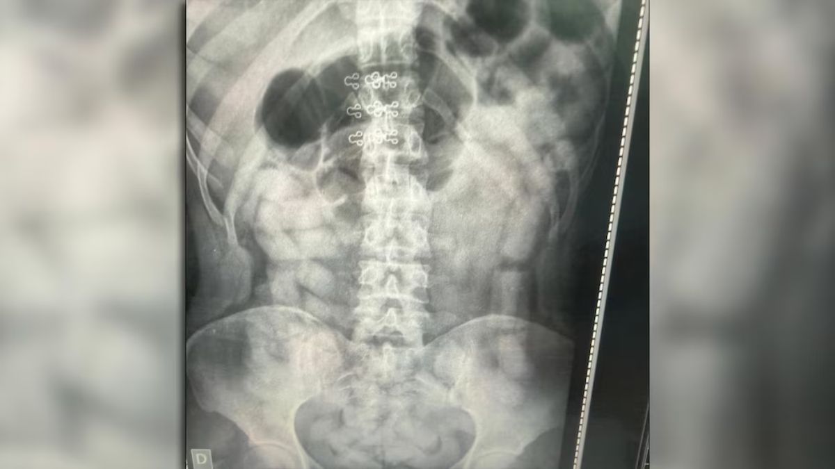 Llevaban 500 cápsulas de cocaína en el estómago: detuvieron a seis “mulas” en el límite entre Tucumán y Catamarca