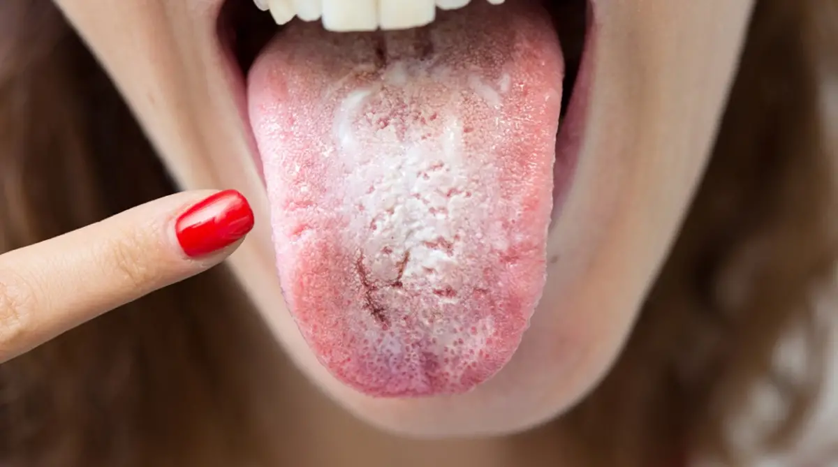 No son los dientes: cuál puede ser el origen del mal aliento a largo plazo