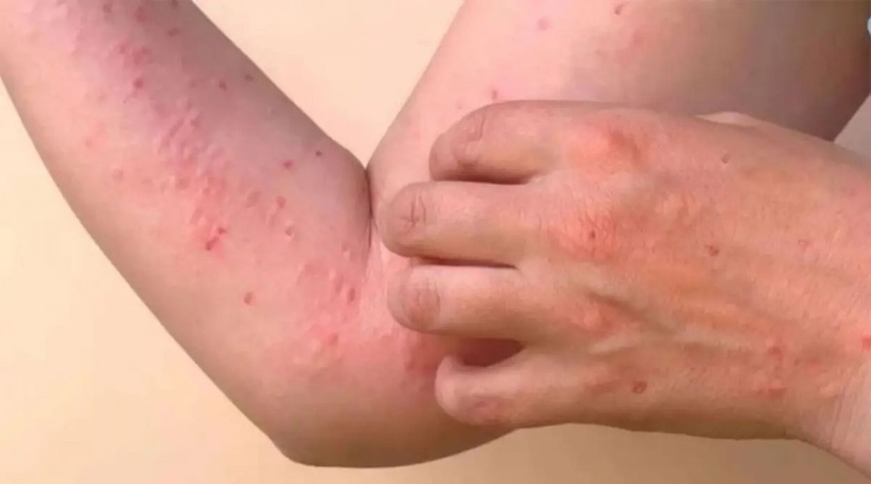 SÍNTOMAS. El sarpullido puede aparecer días después de la fiebre alta.