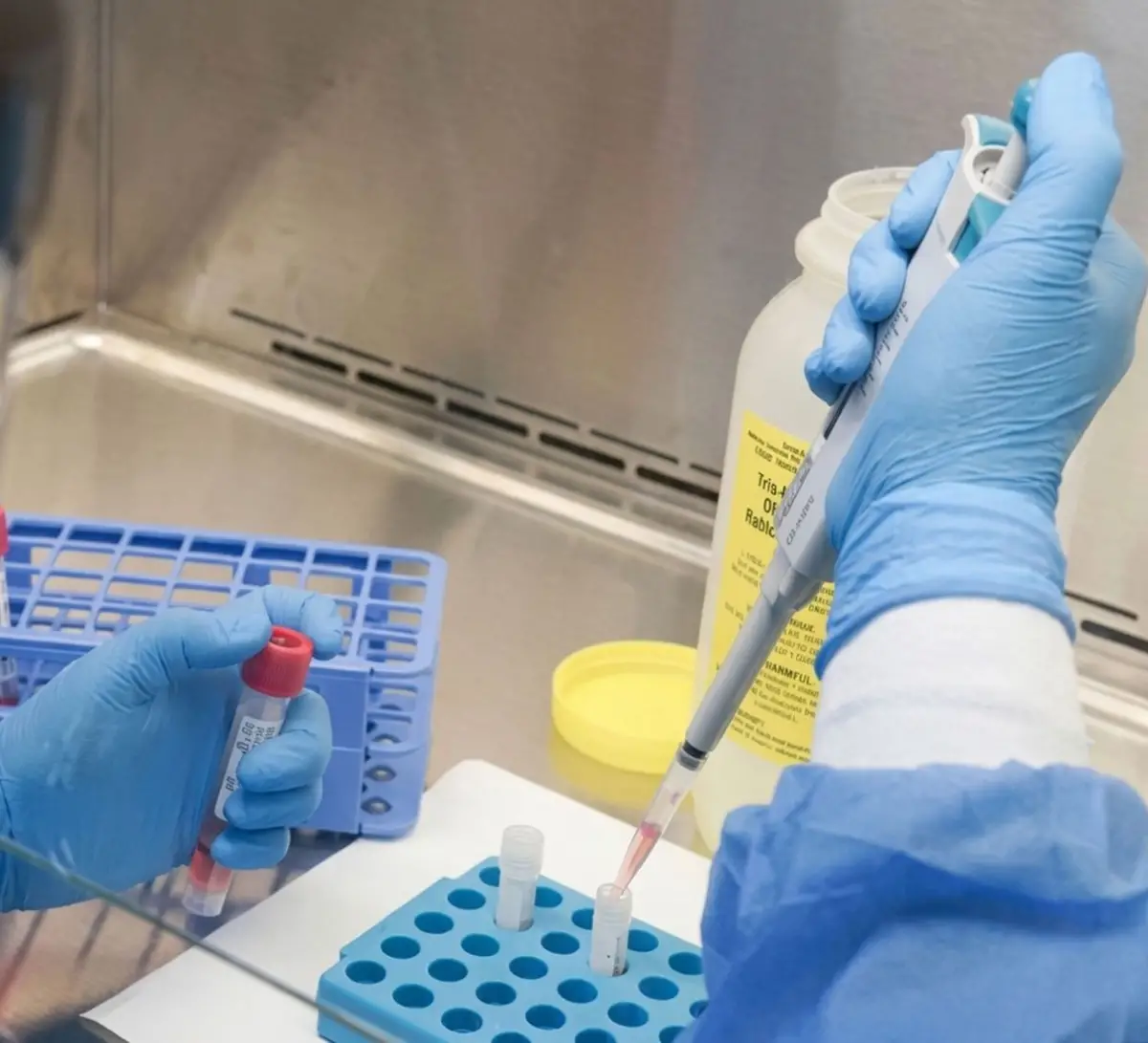 DIAGNÓSTICO. El chikungunya se confirma con análisis de laboratorio.