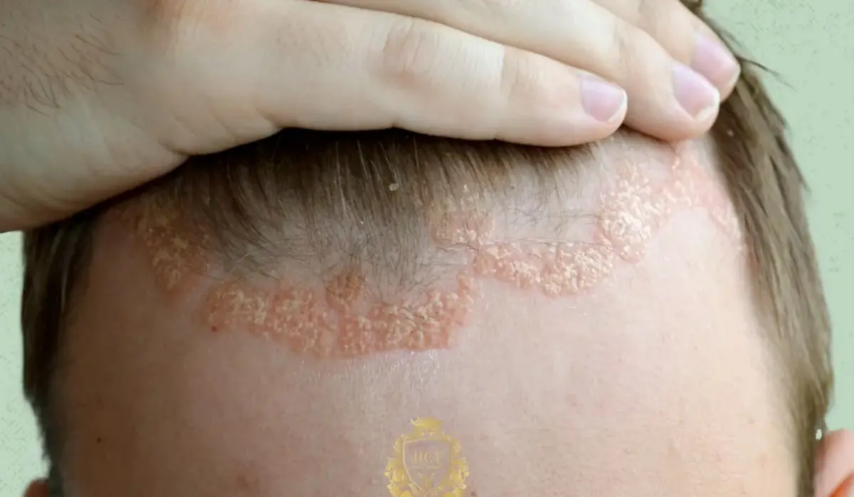 Estados Unidos aprobó una pastilla para la psoriasis que promete eliminar lesiones cutáneas
