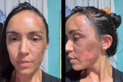 Las quemaduras no se comparan con la desesperación de mi hija al verme así, dijo la mujer atacada en el partido de hockey