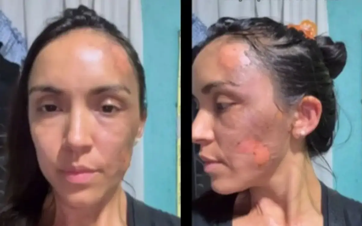 QUEMADURAS. Las imágenes muestran los daños que sufrió el rostro de María Teresa Miranda