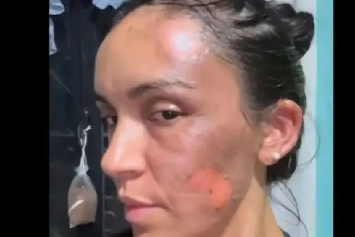 LAS SECUELAS. María Teresa Miranda sufrió quemaduras en el rostro.