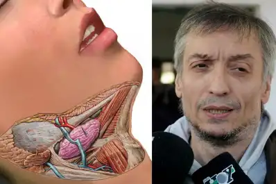 Qué es el cistoadenoma parotídeo bilateral, el tumor por el que operaron a Máximo Kirchner