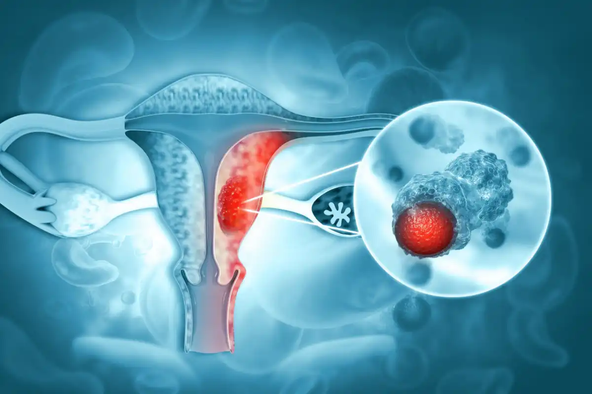 Cáncer de ovario: qué cambios en la menstruación pueden ser una señal de alerta