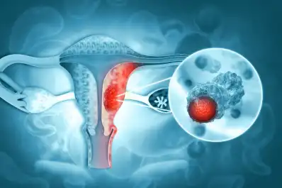 Cáncer de ovario: qué cambios en la menstruación pueden ser una señal de alerta