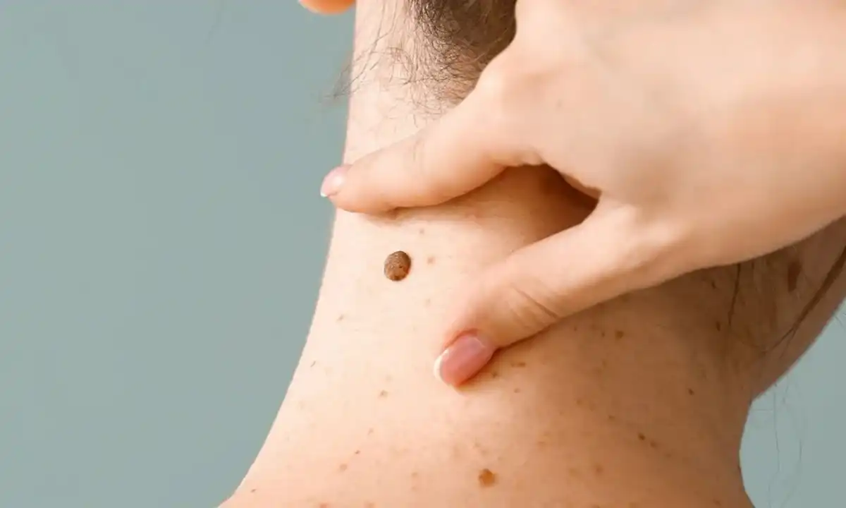Alarma por el aumento de casos de melanoma en la generación z