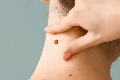 Alarma por el aumento de casos de melanoma en la generación z