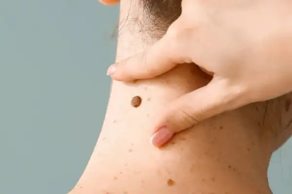Alarma por el aumento de casos de melanoma en la generación z